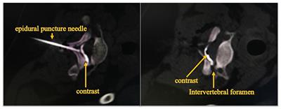 Effects of Continuous Epidural Injection of Dexamethasone on Blood Glucose, Blood Lipids, Plasma Cortisol and ACTH in Patients With Neuropathic Pain